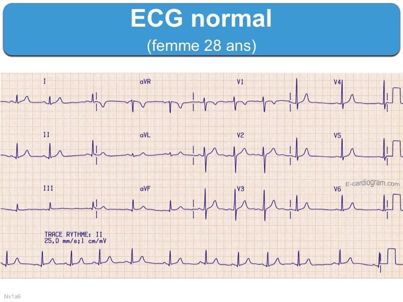 ECG d'une personne normal sans fibrillation.