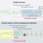 Défibrillateur avec analyse par antériorité du rythme cardiaque, la nouvelle prouesse technologique